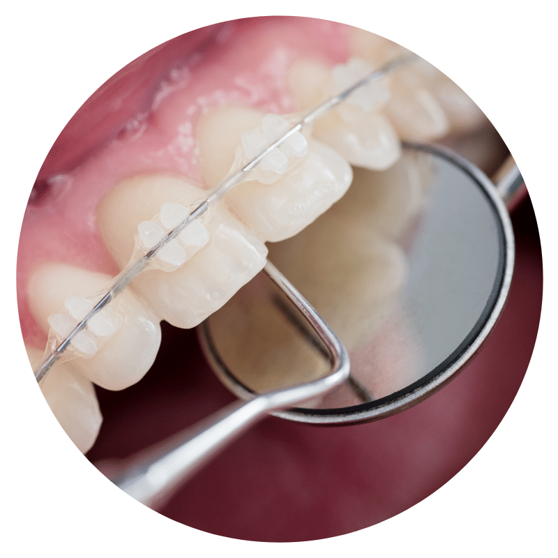 Guide to Braces  Metal, Ceramic, and Lingual Braces